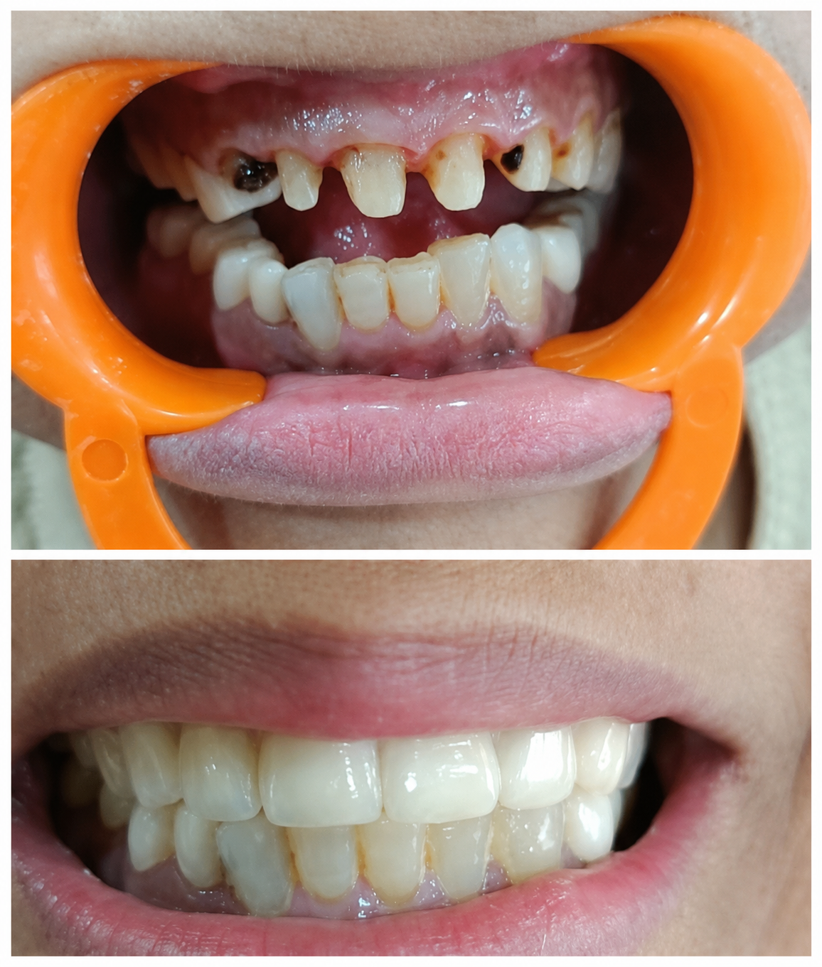 Smile design before and after
