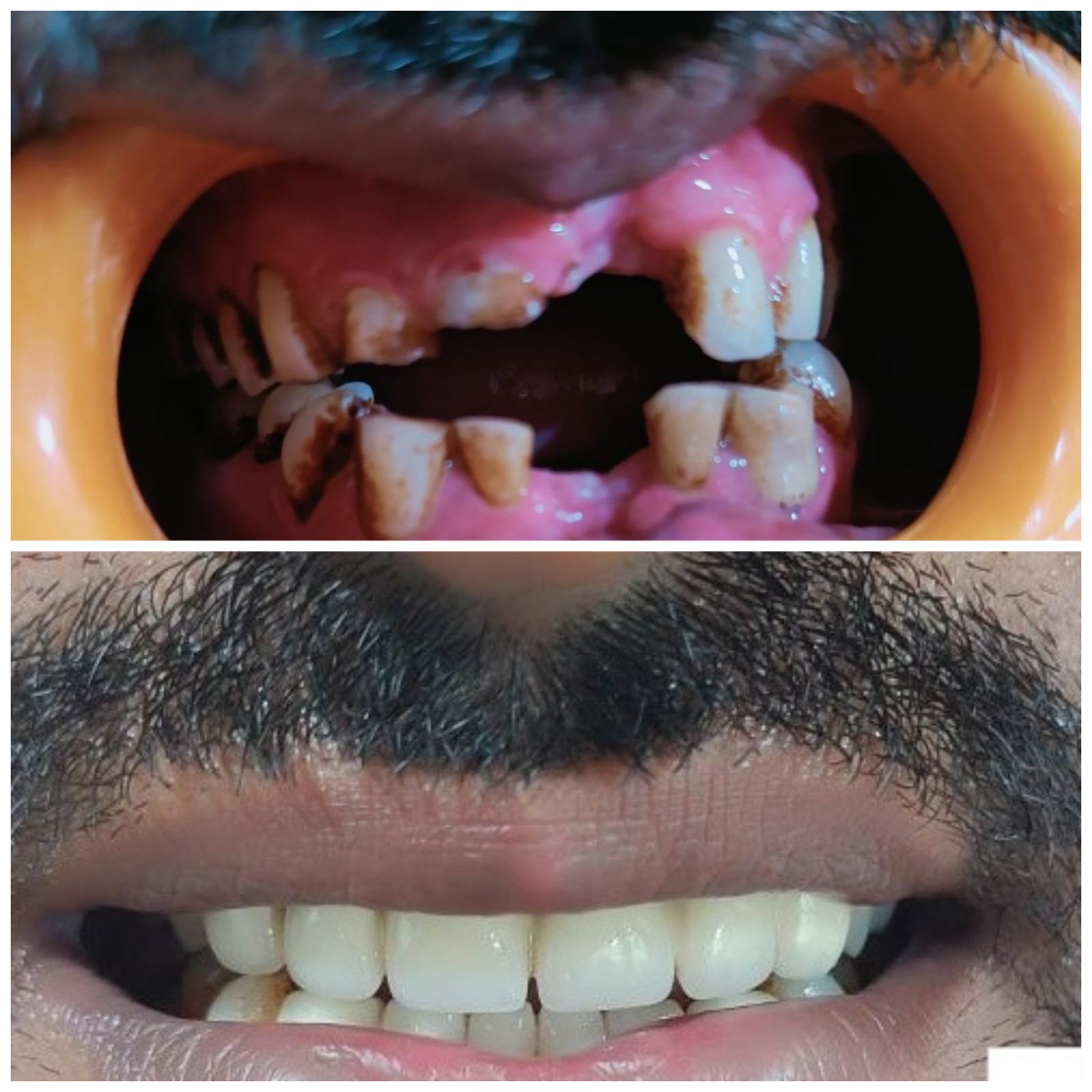 Zirconia crown case