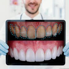 Smile Designing